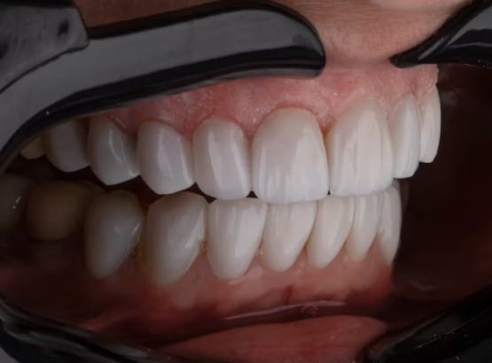 gum disease