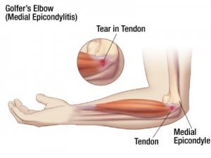 How to Prevent & Treat Golfers Elbow
